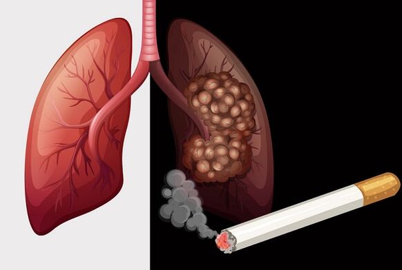 rūkaliaus plaučiai ir sveiki plaučiai